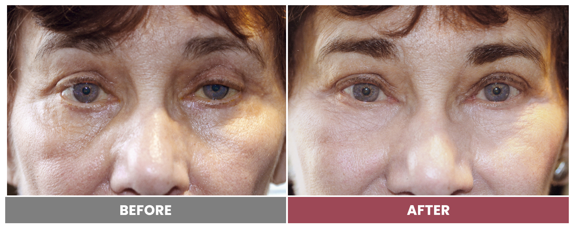PTOSIS REPAIR - Case 50